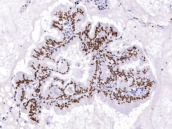 甲状腺转录因子-1 (TTF-1)抗体试剂(免疫组织化学) 甲状腺转录因子-1 (TTF-1)抗体试剂(免疫组织化学)